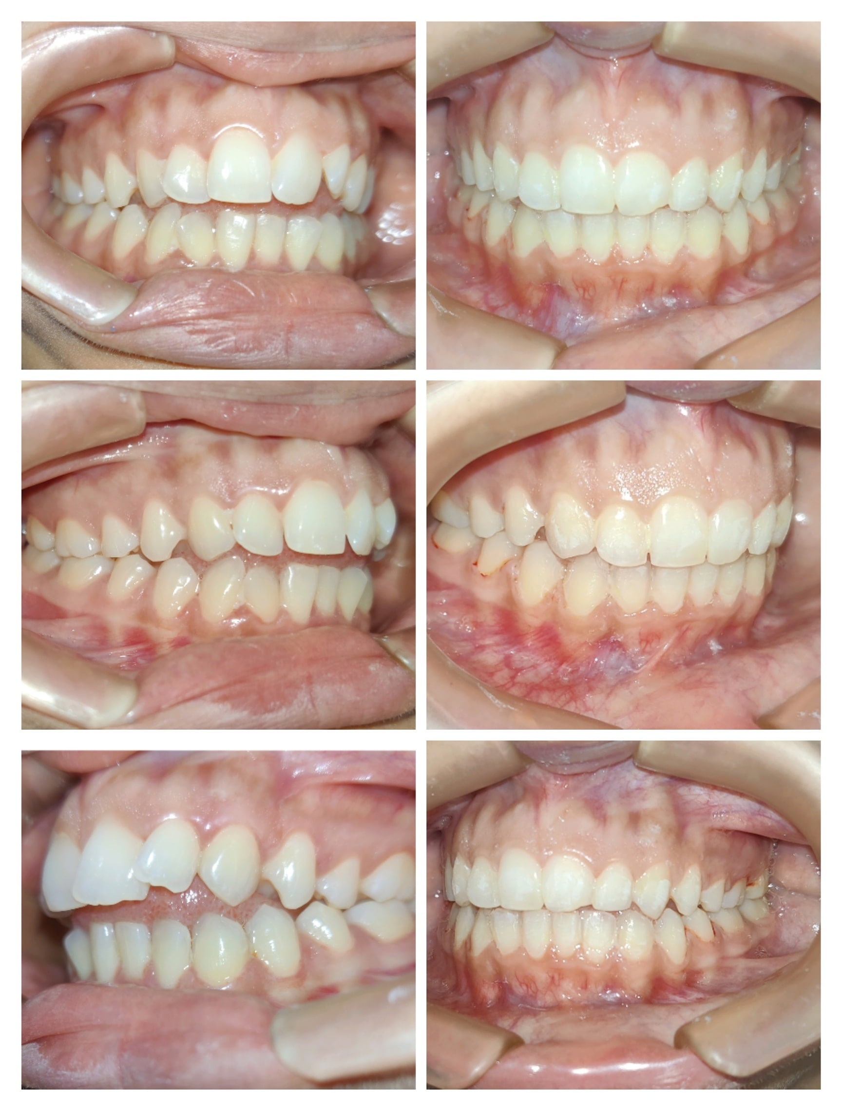 Teeth alignment stages