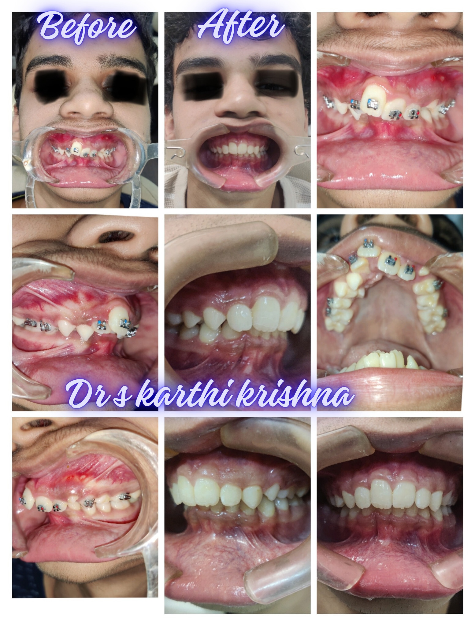 Braces before and after