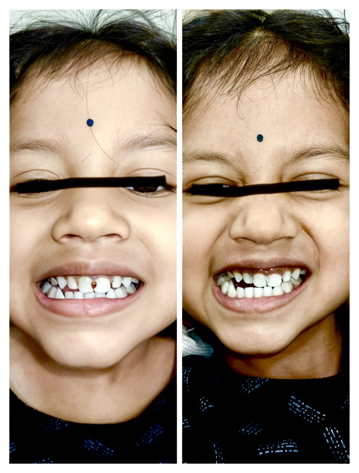 Pediatric teeth correction