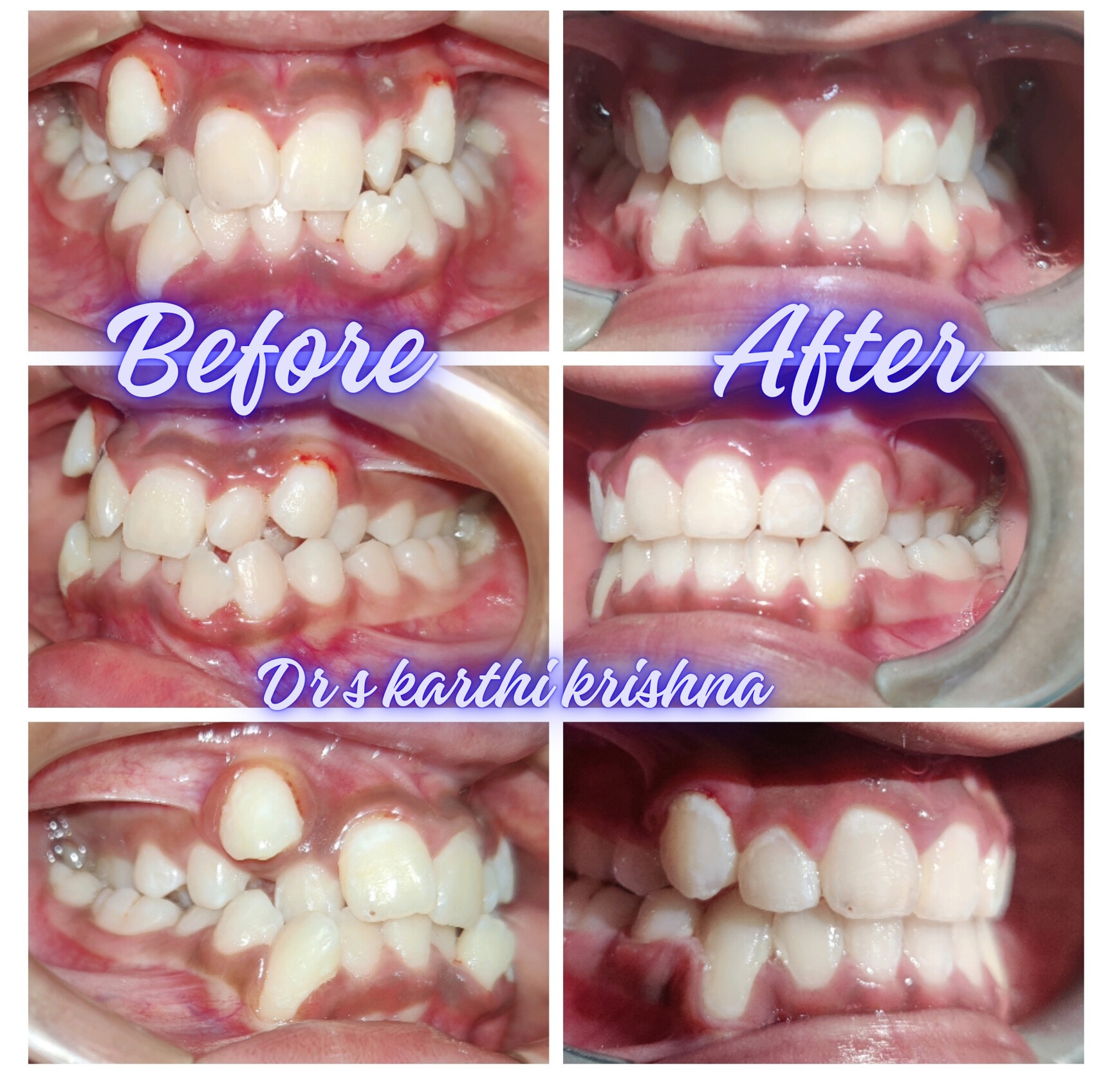 Crooked to straight teeth