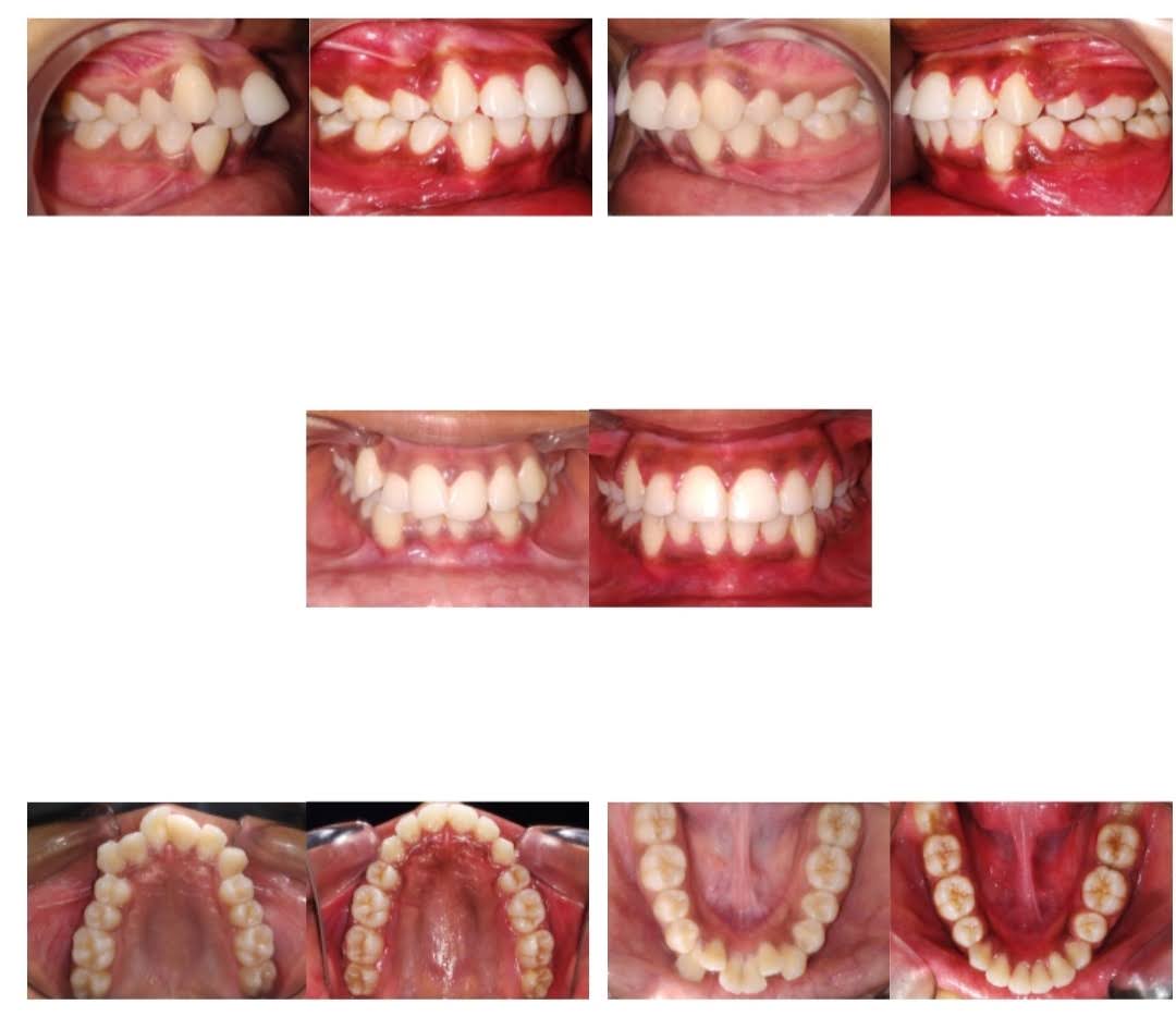 Braces alignment correction