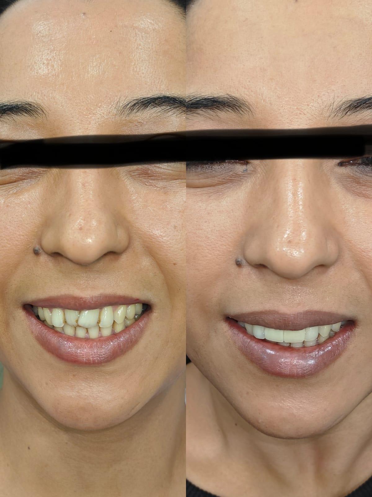 Smile makeover before and after