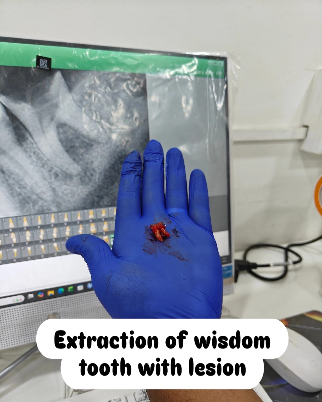 Wisdom tooth extraction