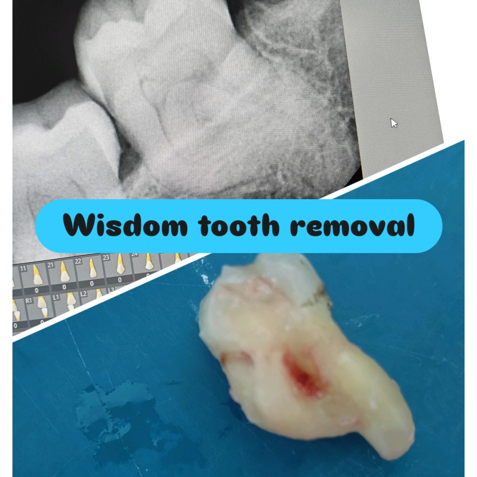 Wisdom tooth removal — X-ray