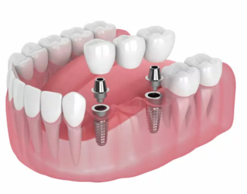 Dental crowns and bridges