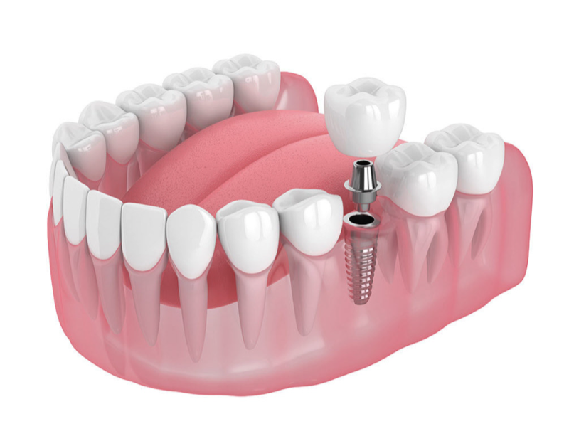 Dental implant with titanium screw