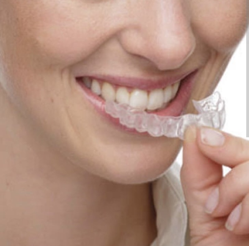 Woman placing clear Invisalign aligner