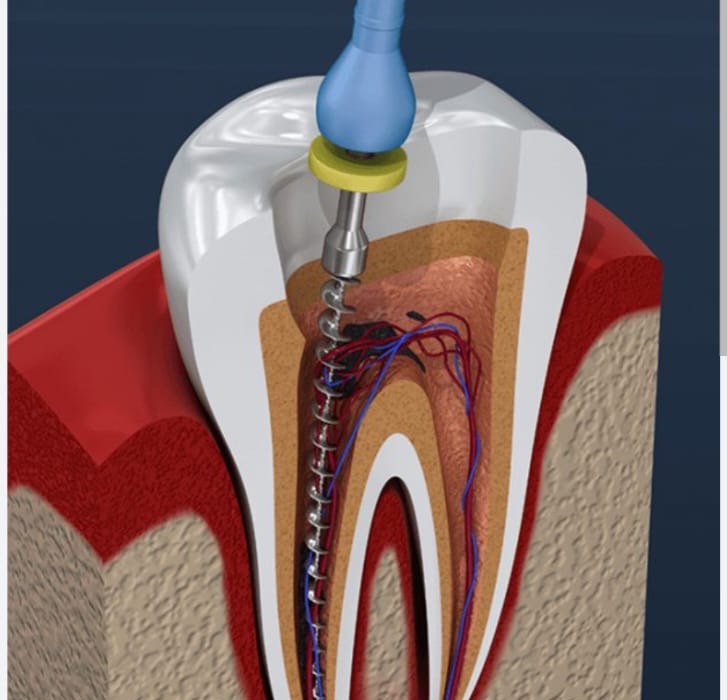 Root canal treatment procedure showing dental drill inside tooth cross-section